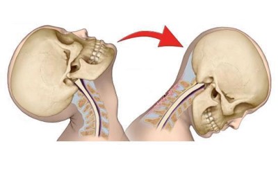 Understanding Whiplash